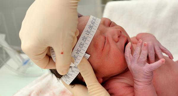 Microcefalia - desordem neurológica em que a circunferência da cabeça é menor do que a circunferência média para a idade e sexo da criança Microcefalia - desordem neurológica em que a circunferência da cabeça é menor do que a circunferência média para a idade e sexo da criança