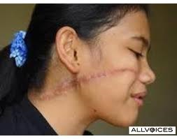 Marcas de tortura